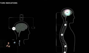 Elon Musk is confident Neuralink will restore vision & full body functionality